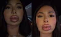 Maeva Ghennam défigurée par une réaction allergique en voulant enlever ses injections